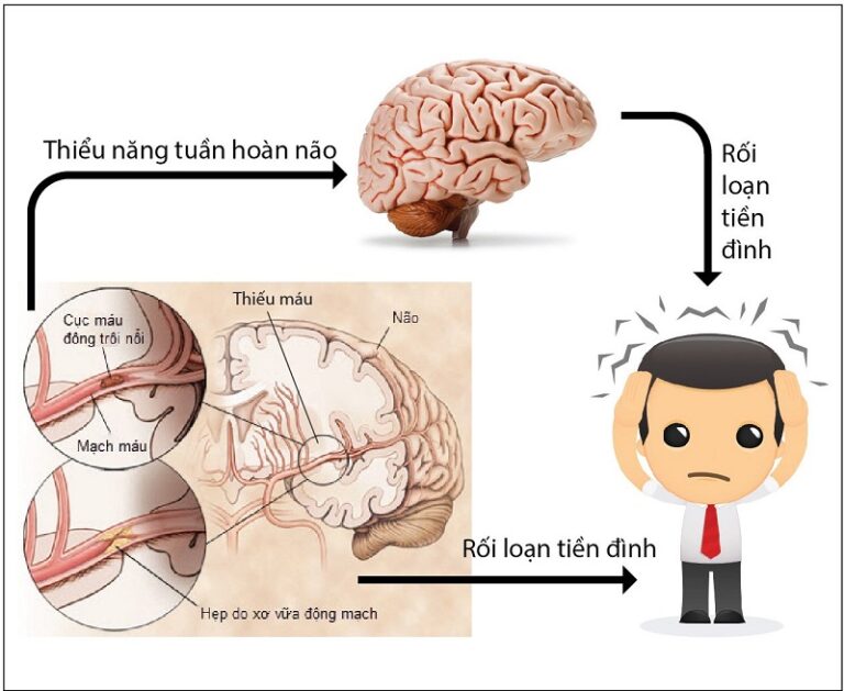 rối loạn tiền đình